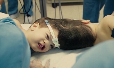 Conjoined twins separated with help of virtual reality in Brazil