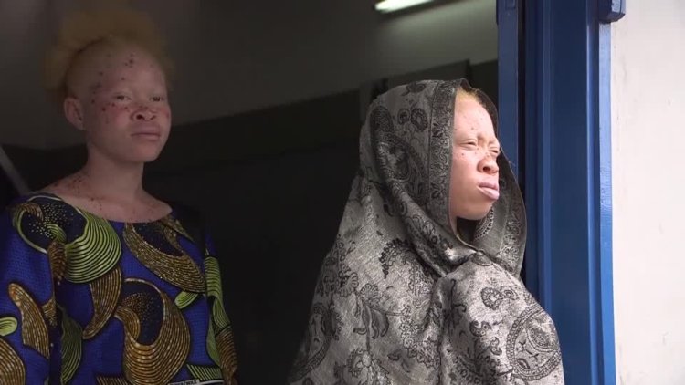 Extreme Heat Poses Risks for Albinism in West Africa