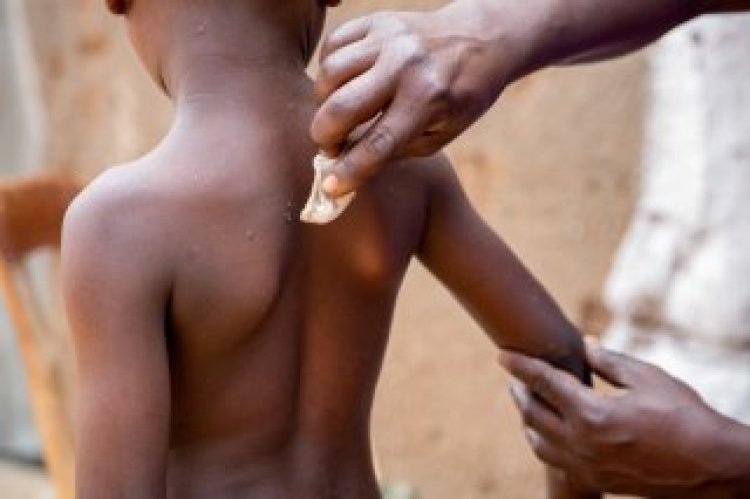 UN official says Burundi can end mpox outbreak soon