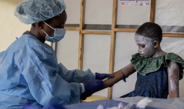 Congo battles mpox outbreak with limited vaccines